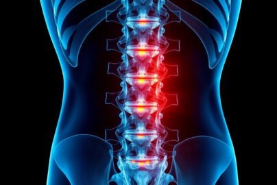 Understanding Lumbar Instability: Symptoms, Causes, and Effective Treatments