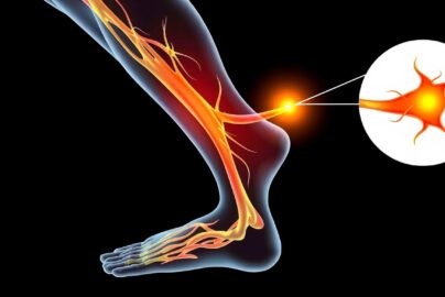 Sciatic Neuropathy: Causes, Symptoms, and Effective Treatment Options