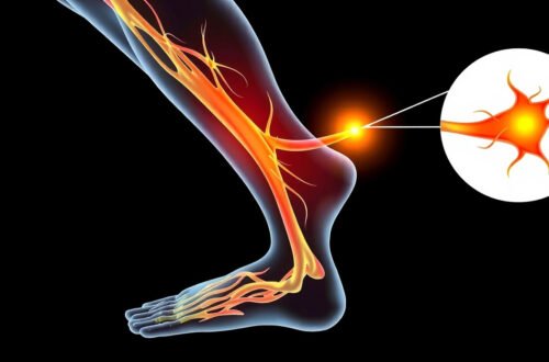 Sciatic Neuropathy: Causes, Symptoms, and Effective Treatment Options