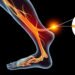 Sciatic Neuropathy: Causes, Symptoms, and Effective Treatment Options