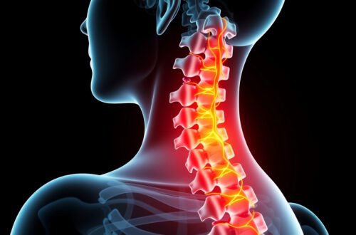 Spinal Stenosis: Causes, Symptoms, and Effective Treatment Options Explained