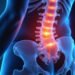 Lumbar Radiculitis: Symptoms, Causes, and Effective Treatment Options