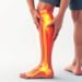 Understanding Sciatic Neuropathy: Symptoms, Causes, and Effective Treatments