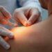 dry needling: Surprising Benefits, Risks, and What to Expect