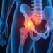 ischiofemoral impingement: Surprising Causes, Symptoms, and Fast Relief