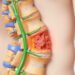 epidural fibrosis: how to prevent, treat and beat recurring back pain