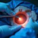 epiduroscopy: a minimally invasive solution for chronic back pain